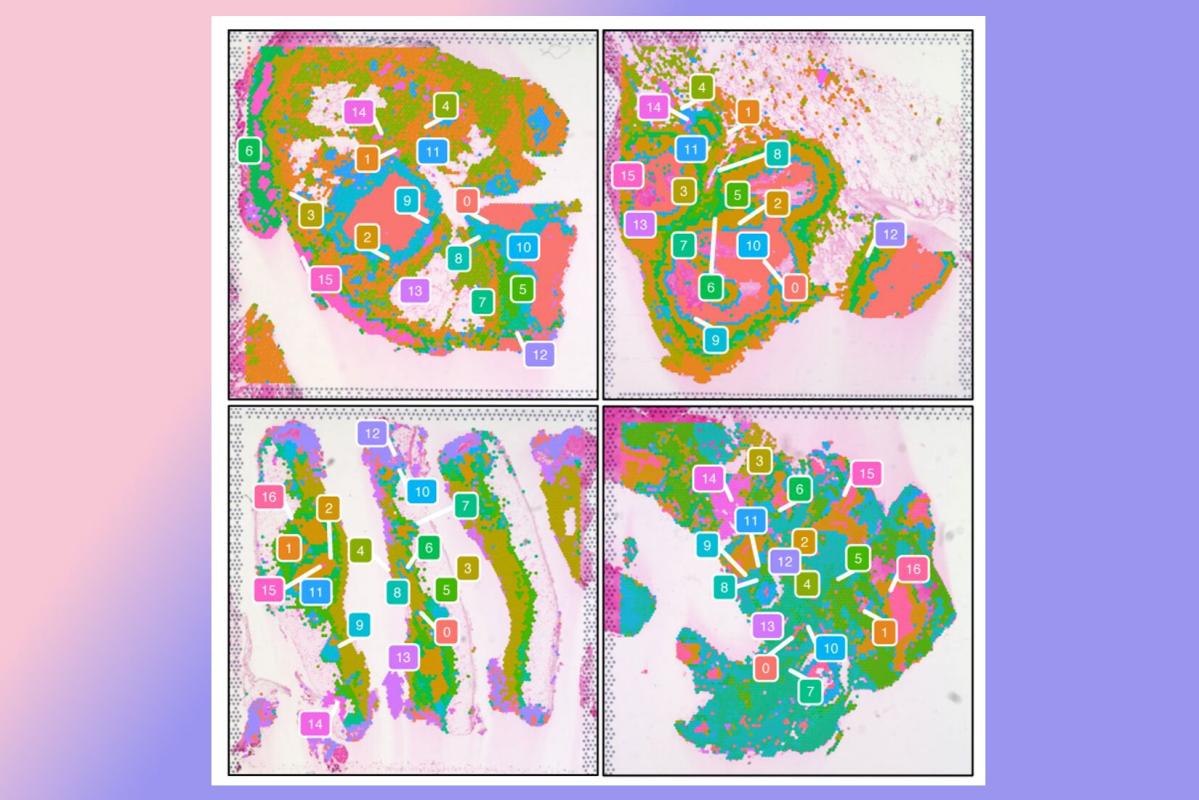 Lung tissue samples showing 17 distinct regions across four TB-infected tissue samples where cells behave similarly. These regions might play different roles in how TB infection develops or persists.