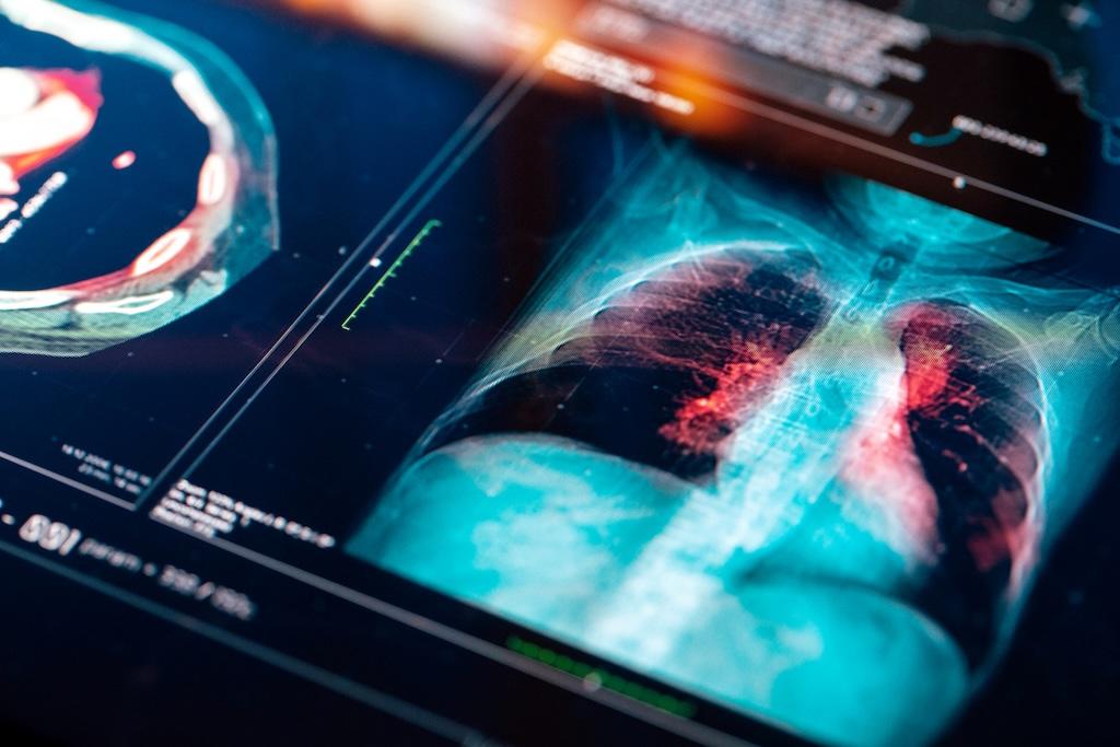 Istock photo of an MRI scan