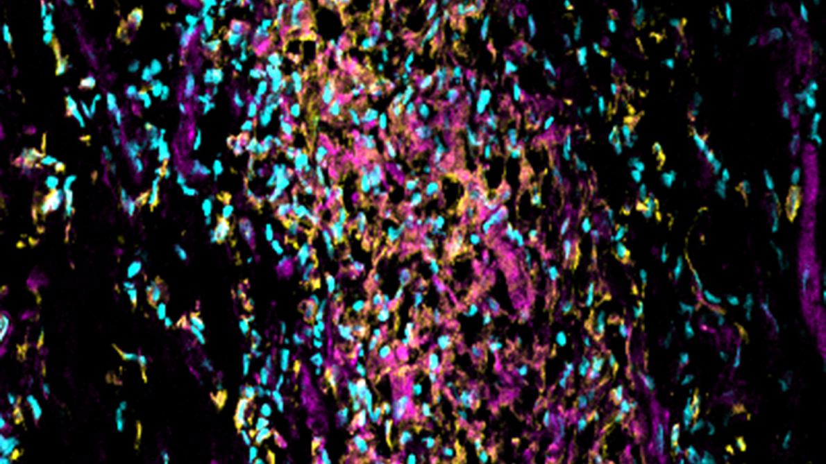 Panel shows an area affected by disease. Yellow highlights immune cells called macrophages, purple shows where tilmanocept is present, and blue marks cell nuclei.